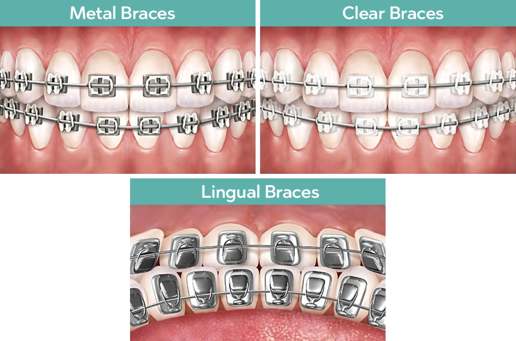 Clear or Invisible braces  What they are and types 🦷