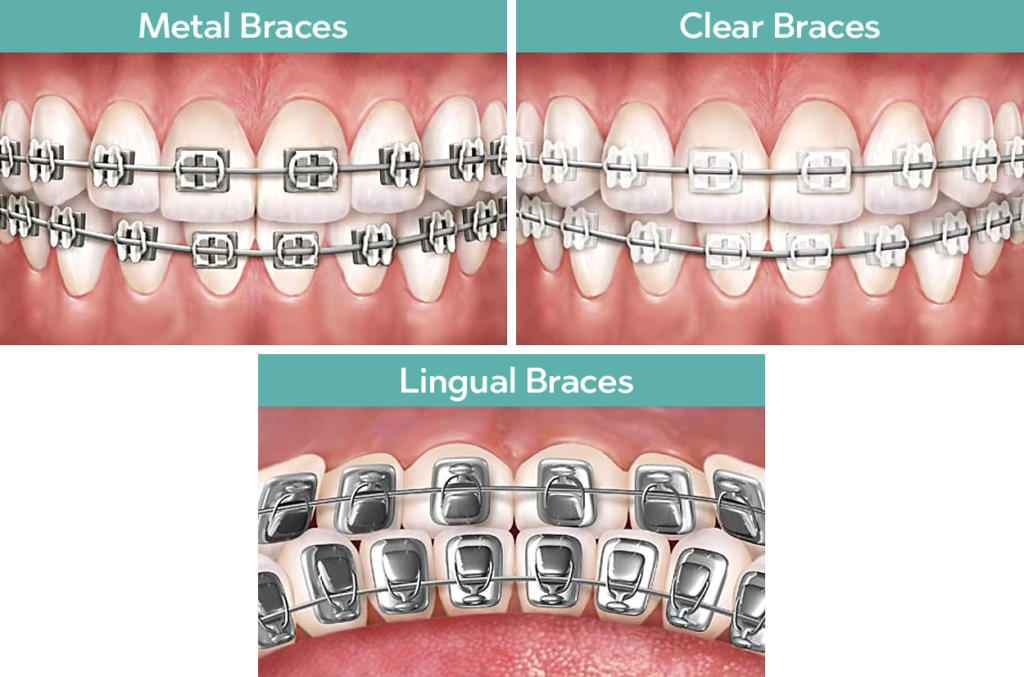 Lingual Braces - Angle House