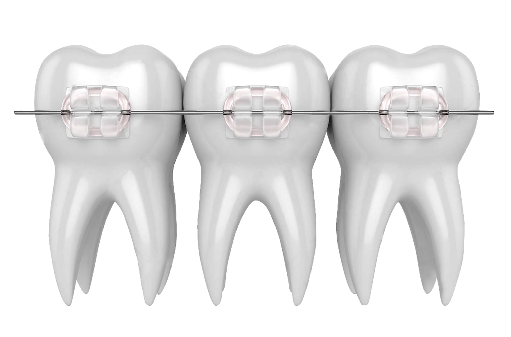 Clear (Ceramic) Braces - Miller Orthodontics