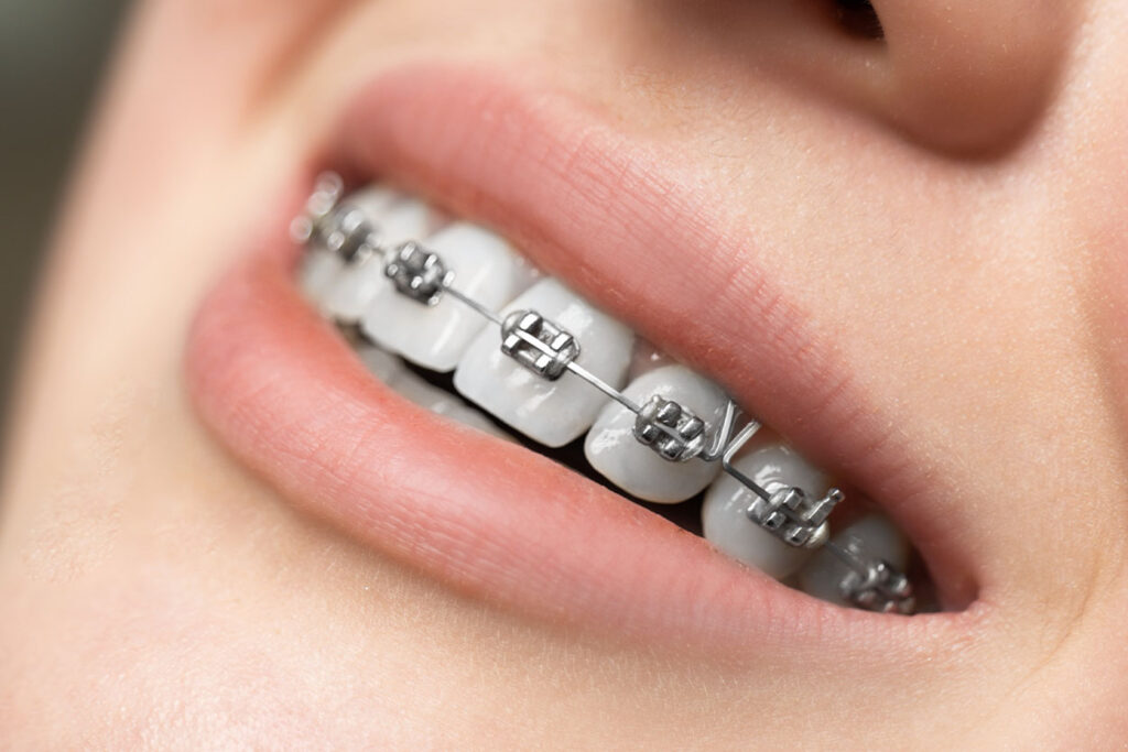 https://anglehouse.com/wp-content/uploads/2021/05/New-Metal-braces-1024x683.jpg