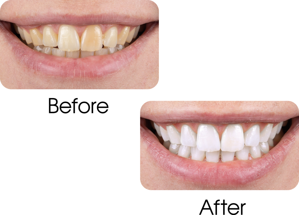 before-and-after-teeth-whitening
