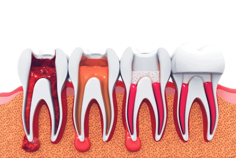 Endodontics and Root Canal Treatment